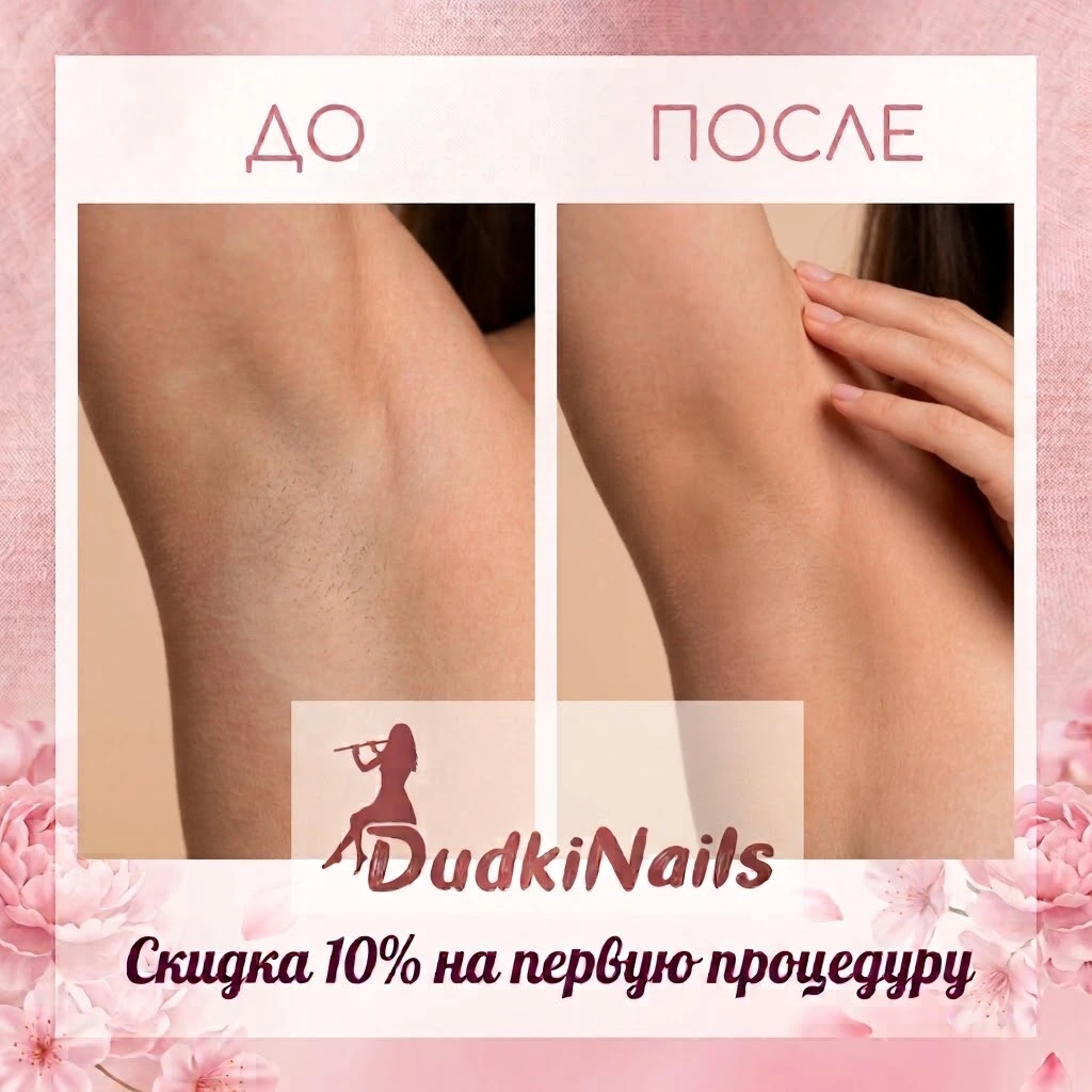 лазерная эпиляция